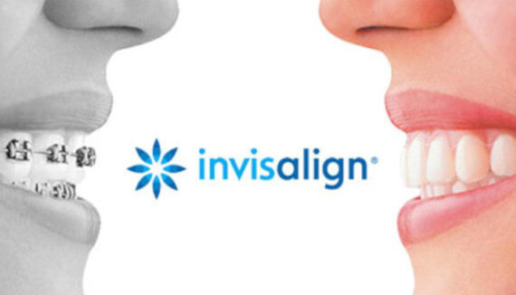 Invisalign